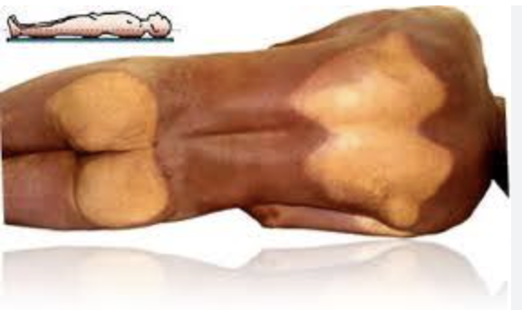 livideces cadavericas explicacion