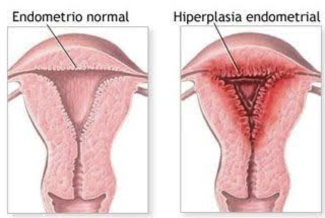engrosamiento del endometrio